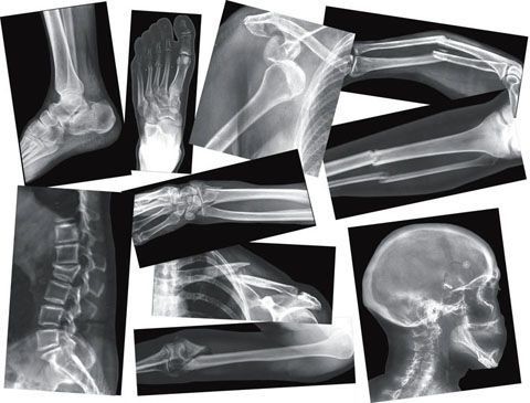 An image of Athena Broken Bone X-Rays